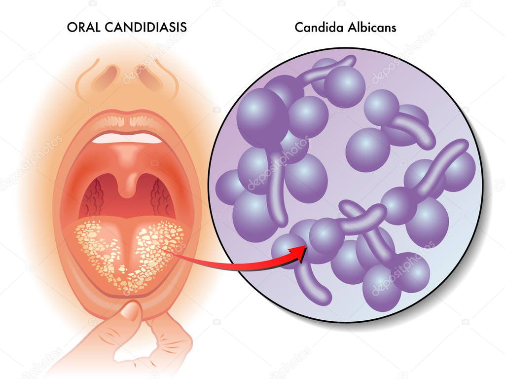 oral candidiasis bacteria, vector illustration