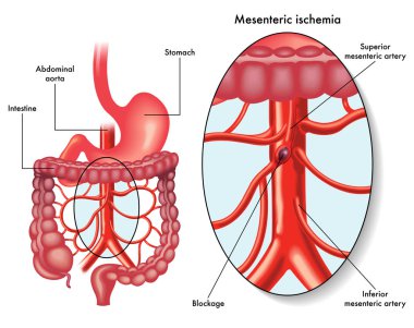 mesenteric ischemia, simply vector illustration clipart