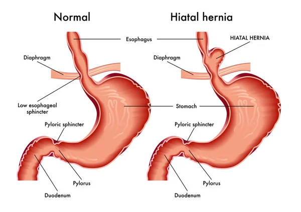 Hernia Hiatal Simplemente Ilustración Vectorial — Vector de stock