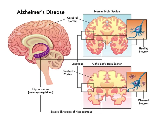 Alzheimer Disease Vector Illustration — Stock Vector