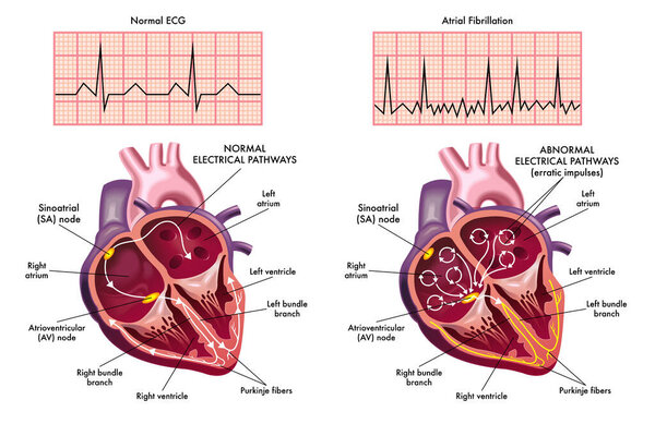 atrial fibrillation vector illustration