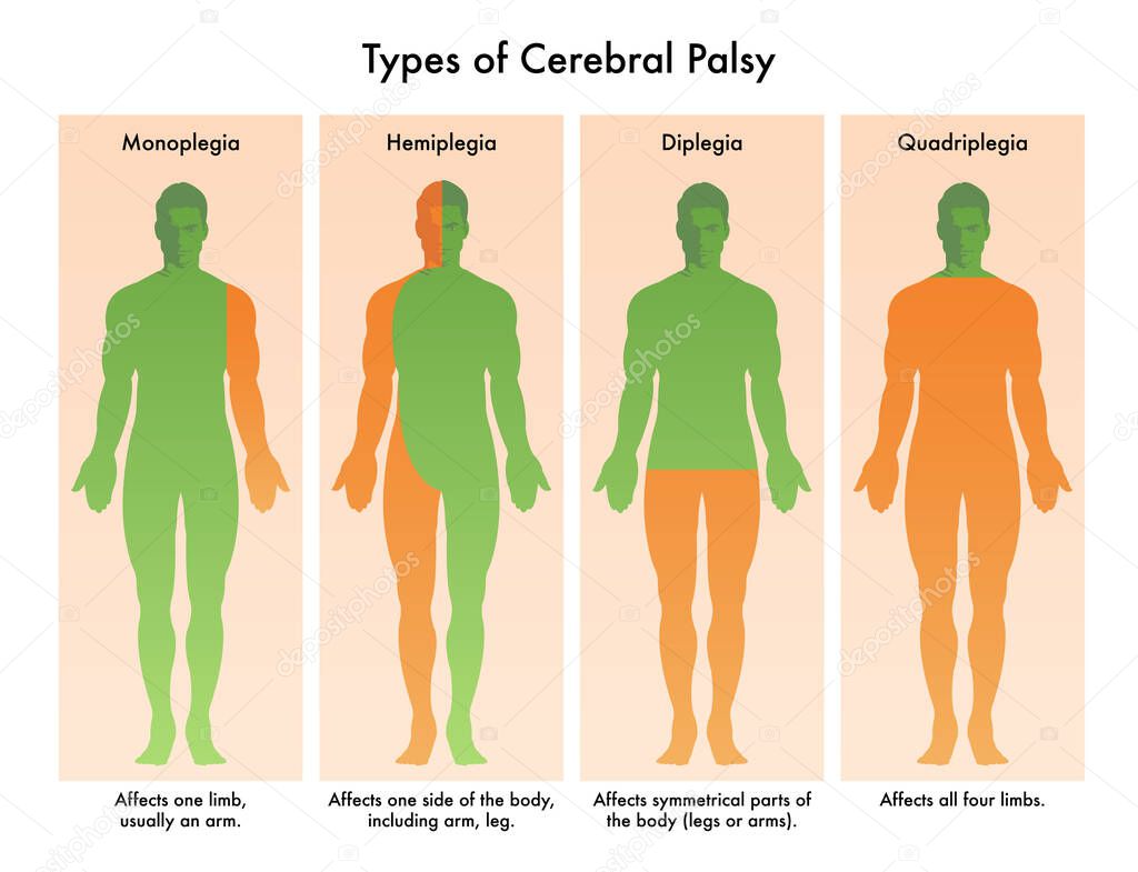  types of cerebral palsy vector illustration