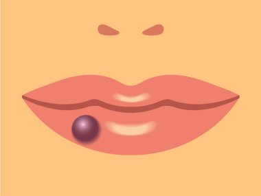 venöz göl hastalığı taşıyıcı illüstrasyonu