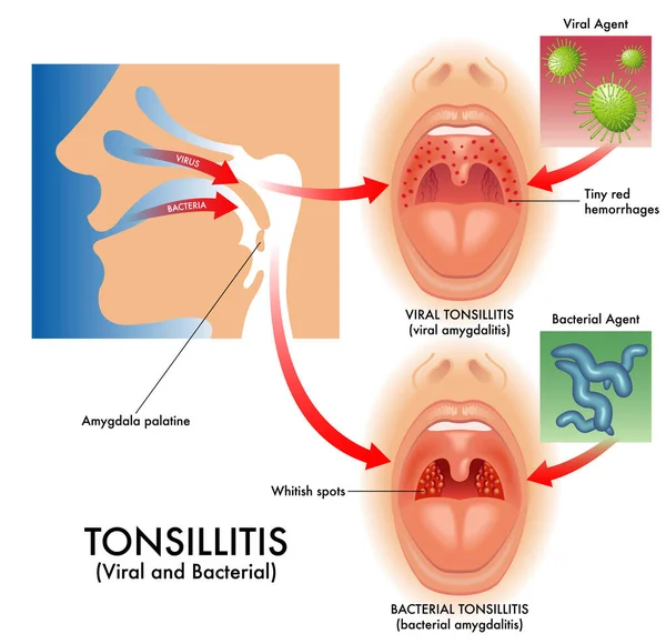 Vector Illustration Detailed Human Tonsillitis White Background — Stock Vector