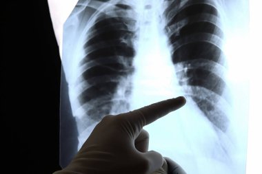 Bir doktorun elleri ve akciğerlerin röntgeni, bir hastanın göğsü. 