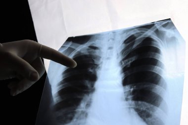 Bir doktorun elleri ve akciğerlerin röntgeni, bir hastanın göğsü. 