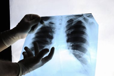 Bir doktorun elleri ve akciğerlerin röntgeni, bir hastanın göğsü. 