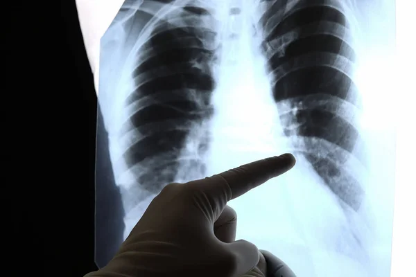 Kezét egy orvos és egy röntgen a tüdő, mellkasát egy beteg — Stock Fotó