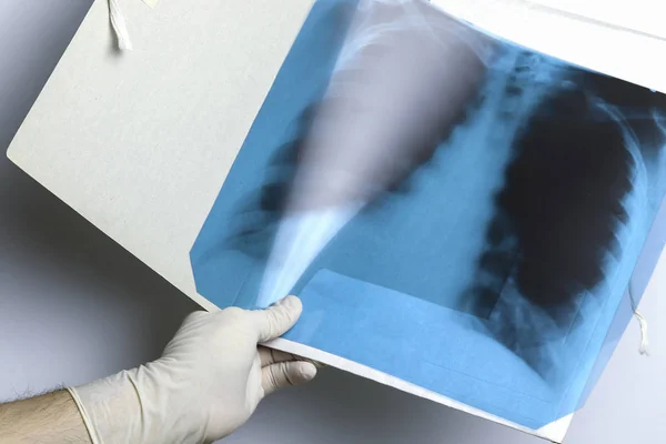 Las manos de un médico indican una radiografía de los pulmones, el pecho de una palmadita — Foto de Stock