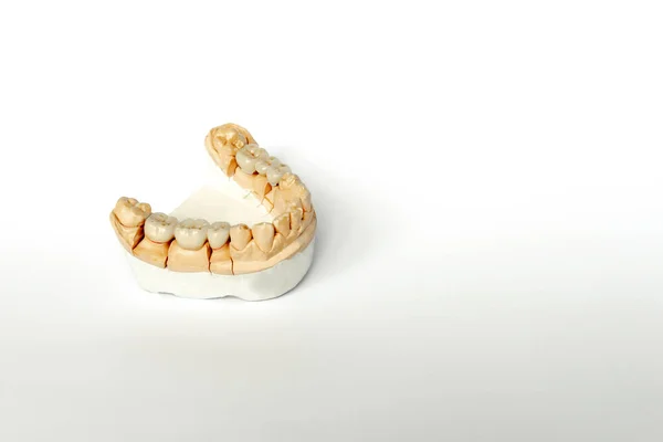 Odontología ortopédica. concepto de reemplazo dental. prótesis dentales —  Fotos de Stock