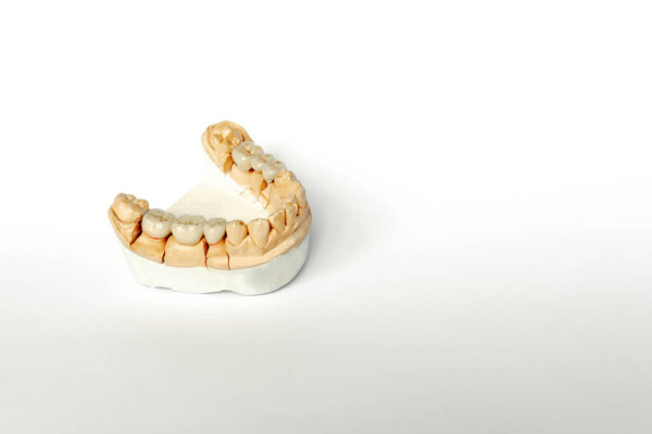 orthopedic dentistry. tooth replacement concept. dental prosthetics