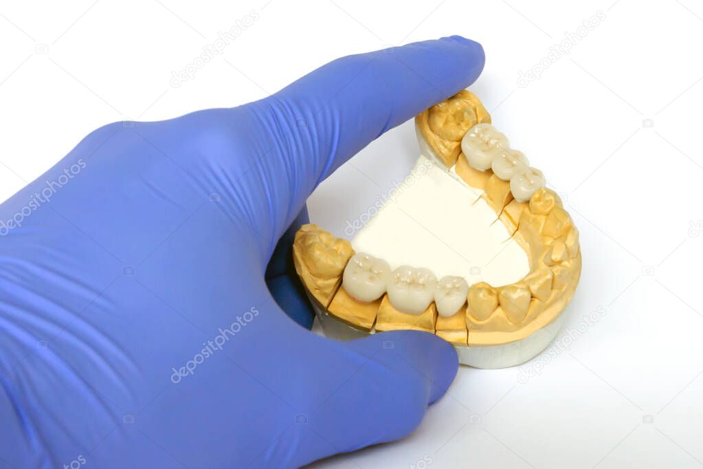 dental crowns and bridges on the teeth of the lower jaw. dental prosthetics concept. replacement and prosthetics of missing teeth. orthopedic dentistry