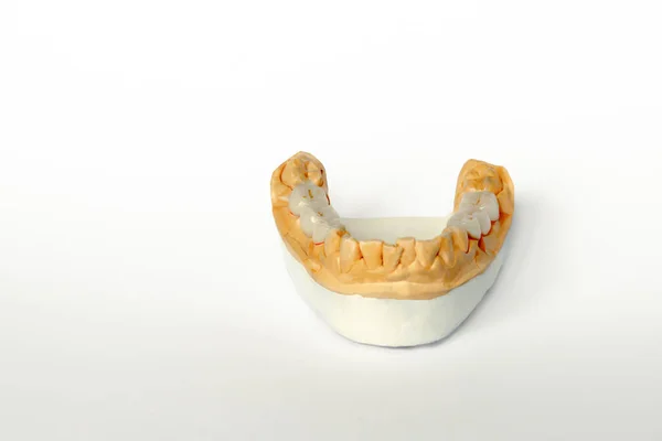 Sztuczne zęby. protezy mostkowo-ceramiczno-metalowe. Ceramiczne protezy zębów w modelu gipsowym dolnej szczęki — Zdjęcie stockowe