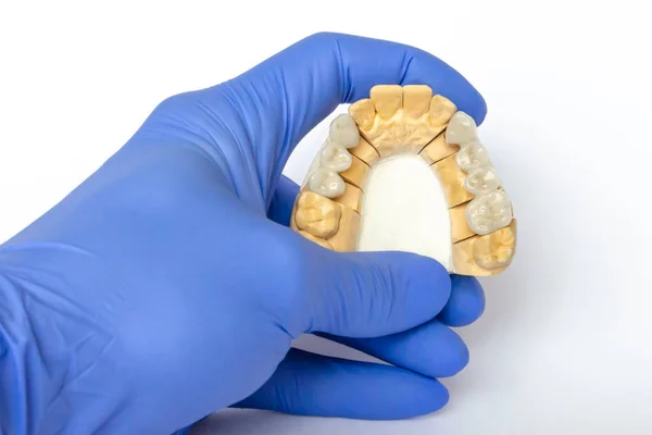Dientes falsos. dientes de cerámica. puentes dentales. odontología ortopédica. puentes cermet están en el modelo de yeso después de la fabricación . —  Fotos de Stock