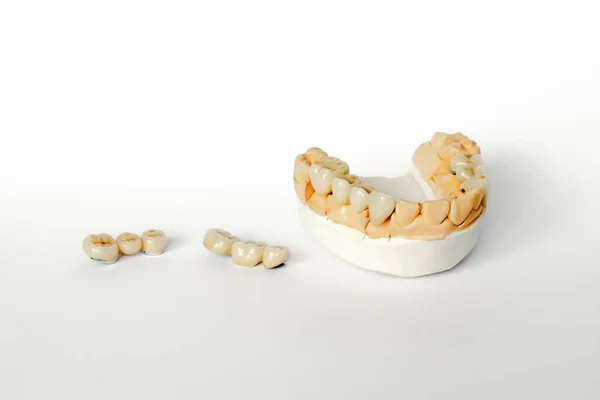 Odontología ortopédica. concepto de reemplazo dental. prótesis dentales. dientes de cermet. puentes de cerámica. modelo de yeso de mandíbula y dientes. Fondo blanco —  Fotos de Stock