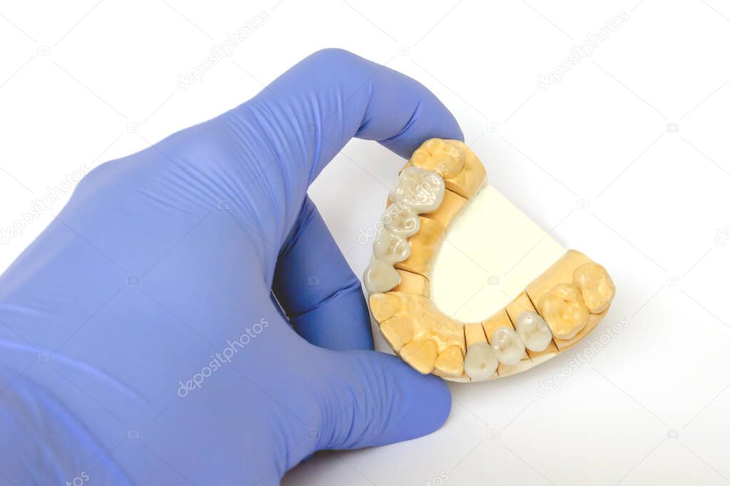 manufacture of cermet teeth. making false teeth. ceramic teeth. ceramic bridges. prosthetics on ones teeth