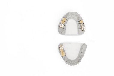 Ortopedik dişçilik geçmişi. Diş protezi geçmişi. Yapay diş kavramı. dişler izole