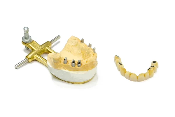 Diş implantları. İmplantlarda diş seramik kaplamalar. Ayağındaki yapay dişler. Yapay köklerde seramik taçlar. izole