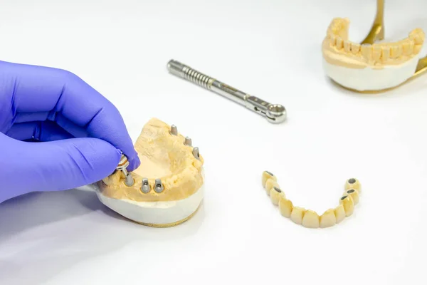 Producción de una dentadura fija en implantes. puente cerámico sobre implantes. dentista mano desenrosca estribo —  Fotos de Stock
