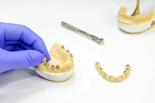implantlarda sabit takma diş üretimi. İmplantlarda seramik köprü. dişçi eli vidaları söker