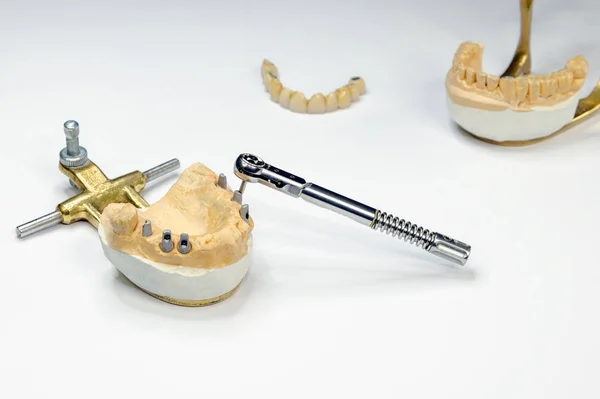 Implantación dental. antecedentes de implantes dentales. concepto de implante dental. la llave desenrosca el implante dental. fondo claro —  Fotos de Stock