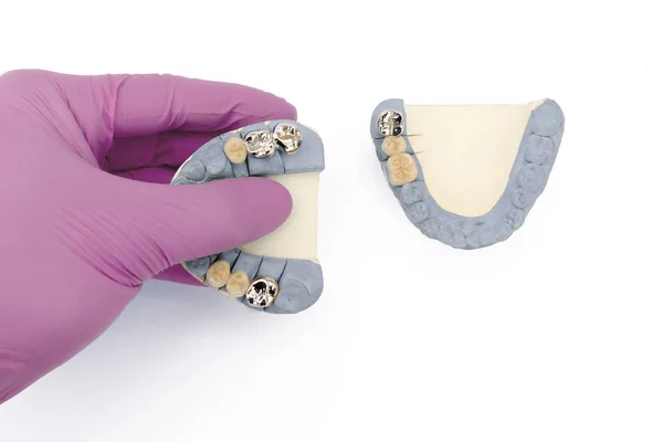 Coronas de cerámica-metal y puentes en las mandíbulas superior e inferior. prótesis dentales. concepto de odontología —  Fotos de Stock