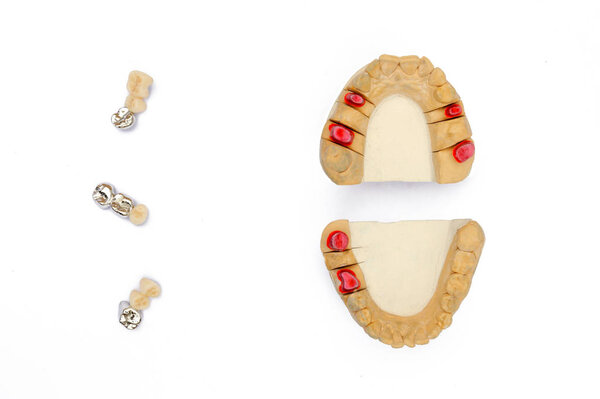 dental prosthetics. prosthetics with crowns of damaged teeth. dental treatment with crowns. dental prosthetics concept