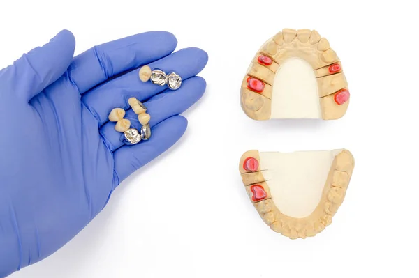 Tło protetyki dentystycznej. sztuczne zęby. Korony i mosty są w rękach dentysty. modele gipsowe szczęki górnej i dolnej — Zdjęcie stockowe