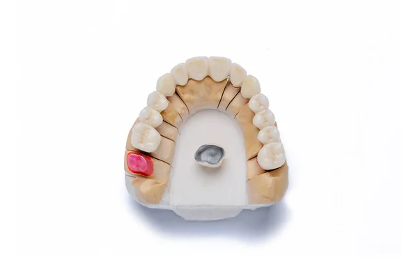 Corone in ceramica-metallo. ponte in ceramica-metallo. dente artificiale. Denti bianchi. odontoiatria ortopedica. protesi dentarie. Isolato su sfondo bianco — Foto Stock