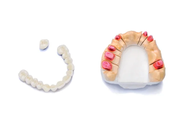 Dental prosthetics. tooth restoration. ceramic white teeth. bridge prosthesis. Isolated on a white background. orthopedic background — Stock Photo, Image