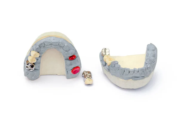 Dientes artificiales de metal y cerámica. concepto de reemplazar los dientes faltantes. prótesis dentales —  Fotos de Stock