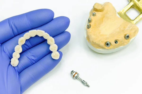 Dişçinin elindeki yapay dişler. Diş implantlarındaki protezler için seramik diş köprüsü. Dişlerinin vidaları sökülmüş ve arka planında diş implantları olan bir model. diş yerleştirme kavramı