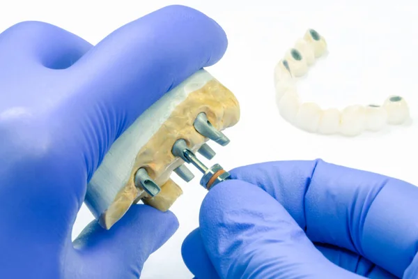 Dişçi diş implantını çevirir. Diş implantlarında protez konsepti ve implantlarda seramik yapay diş üretimi.