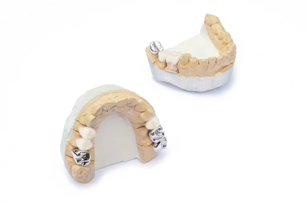 Ceramic-metal bridges on the models of the upper and lower jaws. prosthetics of damaged and missing teeth. isolated — Stock Photo, Image