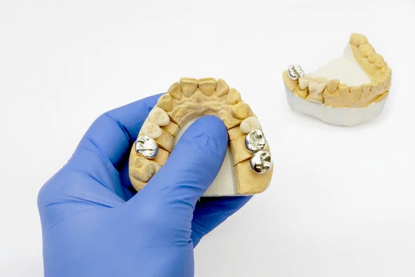 Un dentista con un guante sostiene dientes falsos. en el fondo es un modelo con coronas de metal y cerámica. concepto de odontología ortopédica . —  Fotos de Stock