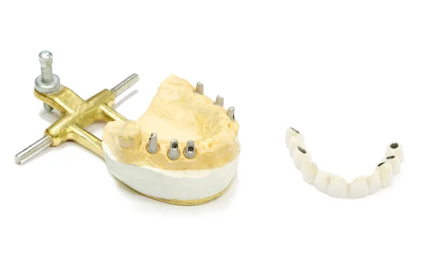 İmplantlarda seramik diş üretimi süreci. Açık arkaplanda seramik dişli diş implantları. İmplantlarda diş implantasyonu ve diş protezi konsepti.