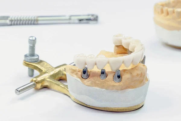 İmplantlarda seramik diş üretimi süreci. Açık arkaplanda seramik dişli diş implantları. İmplantlarda diş implantasyonu ve diş protezi konsepti.