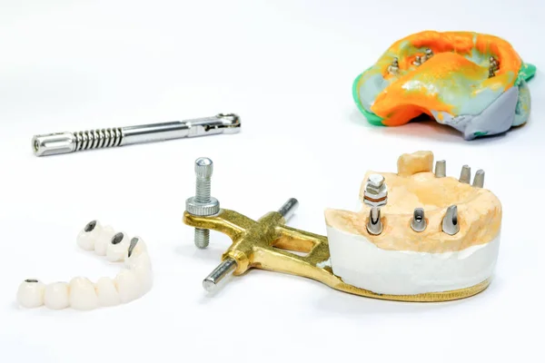 Diş implantı ve seramik kaplamalı çene modeli. Arka planda implantasyon aletleriyle yapılmış bir diş izi var. İmplantlarda diş kaplaması üretimi süreci