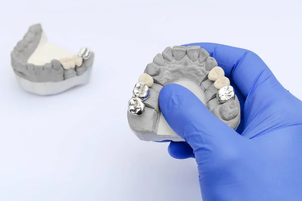 Takma diş. Metal ve seramik taçlar ve köprüler. Dişçinin eli alçı bir model tutuyor. Ortopedik dişçilik kavramı