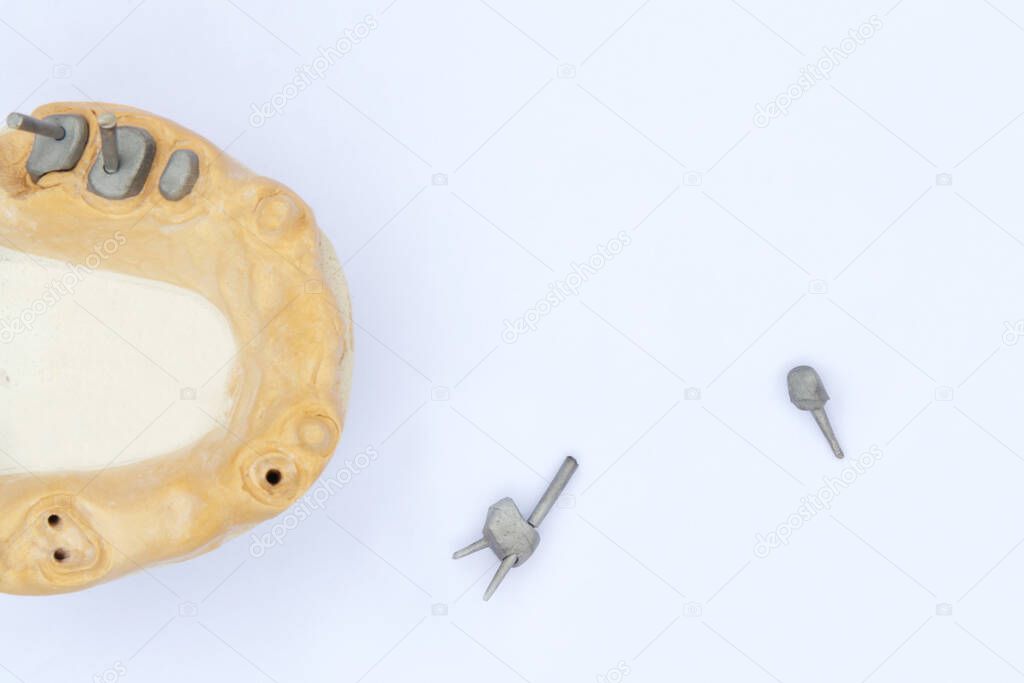 dental pins, posts and cast posts. on the left is a gypsum model of the upper jaw. concept of prosthetics on the roots of teeth. orthopedic dentistry