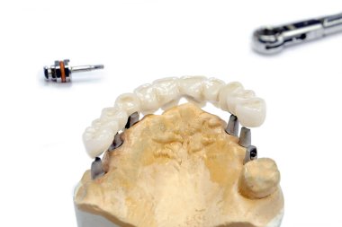 İmplantlarda seramik diş üretimi süreci. Açık arkaplanda seramik dişli diş implantları. İmplantlarda diş implantasyonu ve diş protezi konsepti.