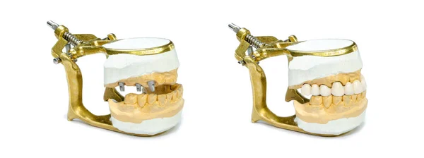 Diş implantı ve ortopedik implantı olan çene modelleri. Protez yerleştirme konsepti. ortopedik dişçilik. Beyaz bir arka planda izole edilmiş. Seramik kaplamalı protezlerden önce ve sonra