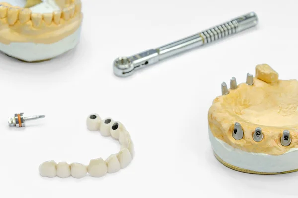 Proceso Fabricación Dientes Cerámicos Sobre Implantes Implantes Dentales Con Dientes — Foto de Stock