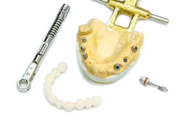 White Ceramic Teeth Dental Implants White Background Torque Wrench Dental — Stock Photo, Image