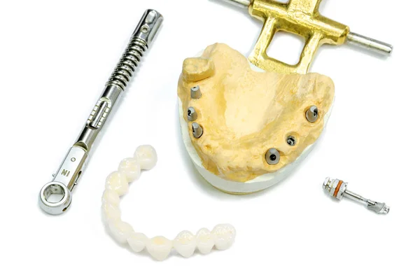 Beyaz arka planda diş implantı olan beyaz seramik dişler. Tork anahtarı ve diş tornavida. İmplantlarda diş implantasyonu ve ortopedik dişçilik kavramı. Diş ayağında bükülme var. arkaplan