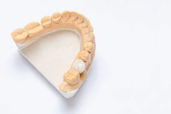 Beyaz arka planda alt çenenin alçı modeli var. Diş implantında seramik taç var. Diş protezi konsepti. taç yapımı