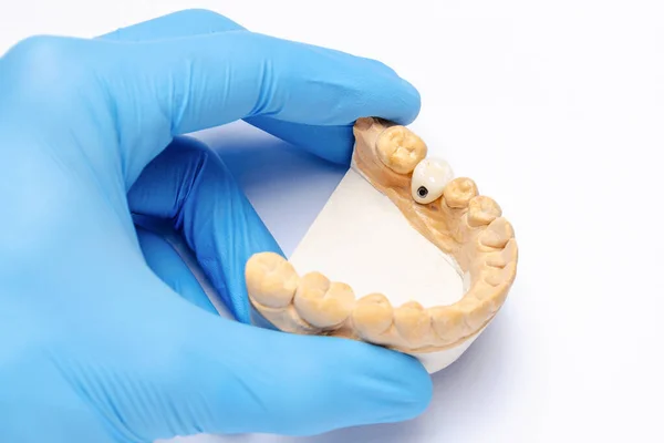 Eldivenli bir el, diş implantında seramik taç olan alt çenenin alçı modelini tutuyor. Diş implantlarında protez konsepti. diş nakli