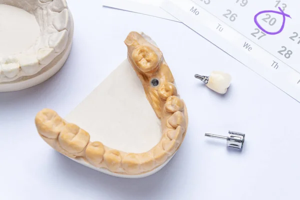 Diş implantı, seramik kaplama ve diş aletine sahip beyaz arka planda, sağ üst takvime göre dişçiye gittiğini gösteren bir cihaz. dişçi randevu kavramı