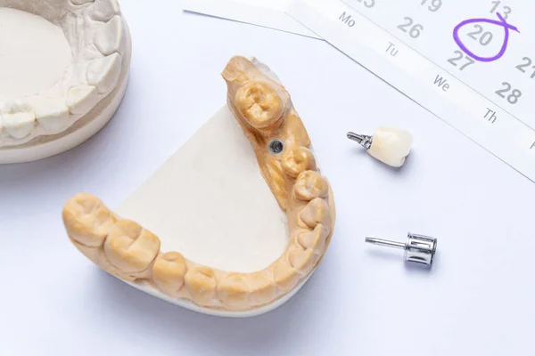 Impianto Dentale Con Corona Ceramica Strumento Dentale Trova Uno Sfondo Immagine Stock