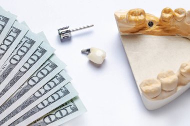 Seramik diş implantı bir diş aleti ve beyaz arka planda implant olan bir diş modeliyle yapılır. Dişin solunda dolar banknotları var. Diş hekimliğinin ve sigortanın yüksek maliyeti kavramı. Dişçilik için para toplamak